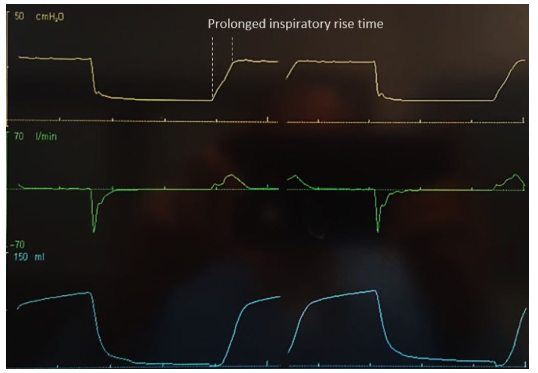 Inspiratory pause, IE ratio and inspiratory rise time Deranged